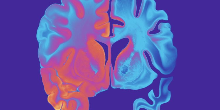 Nuove scoperte svelano come il cervello resiste all'Alzheimer