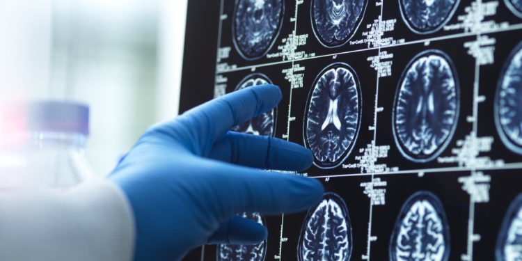 Un farmaco simula l'altitudine per contrastare il Parkinson